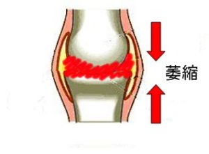 関節包萎縮の図