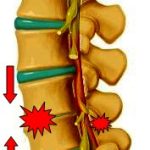椎間板損傷の図