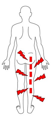 坐骨神経痛の症状をあらわすイラスト